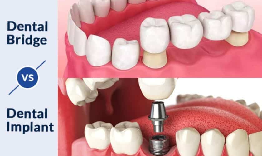dental bridge vs dental implant