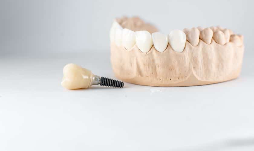 dental implants broken arrow