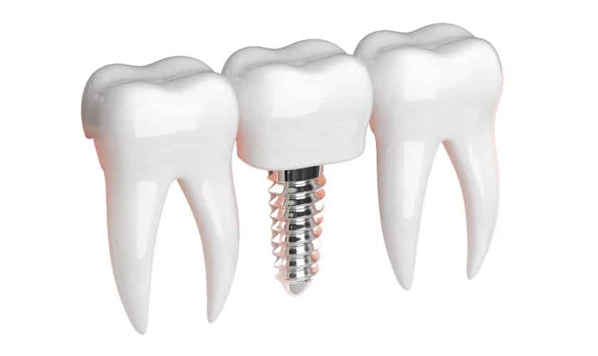 Dental implants in Broken Arrow, OK