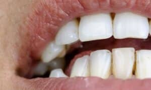 Uneven Teeth Whitening result