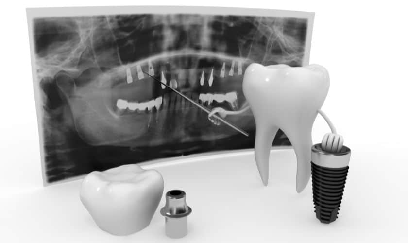 Dental Implant material and its evolution