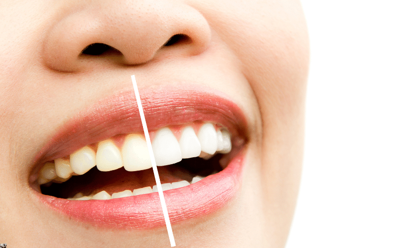 Teeth Whitening Broken Arrow