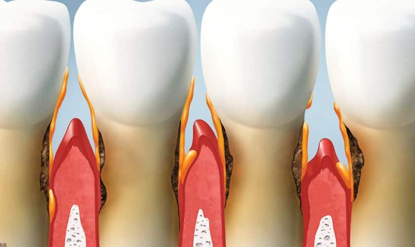 Warning Signs of Gum Disease You Shouldn't Ignore in Broken Arrow