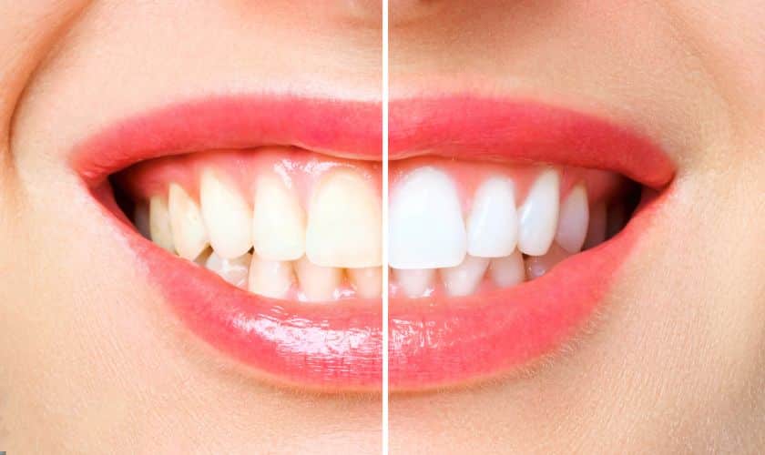 The Art Of Teeth Whitening