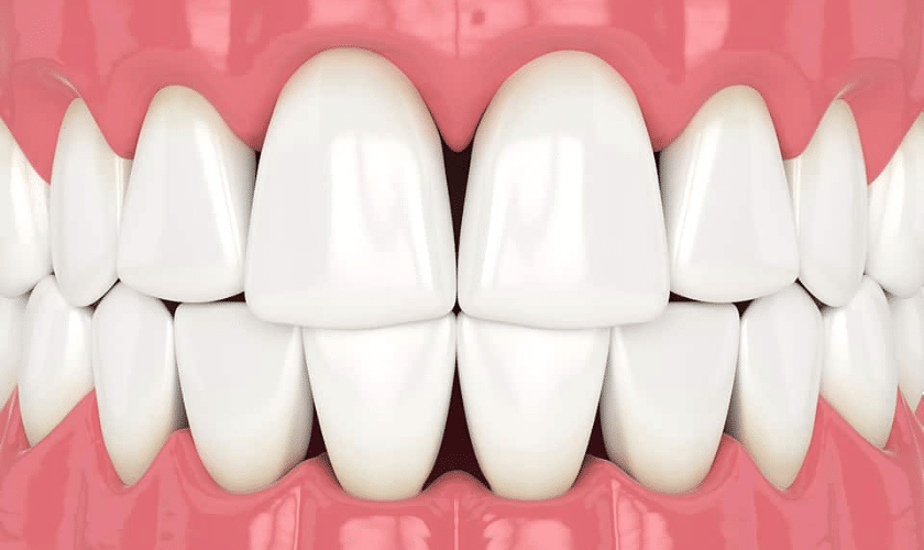 Bioclear Fixes Black Triangles & Diastema in Teeth