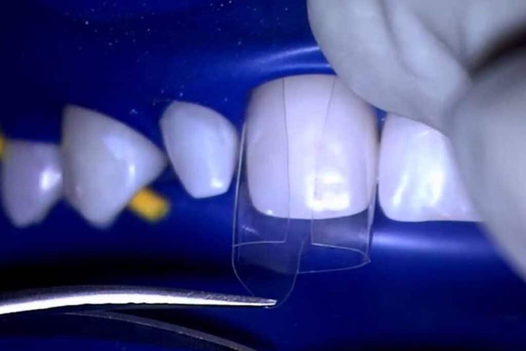 What is Same Day Bioclear 360 Veneers?