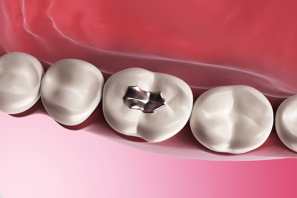 Types of Dental Fillings