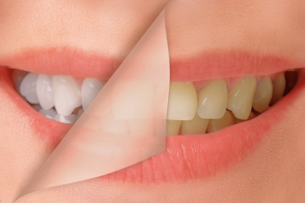 Can you whiten teeth after dental implant?