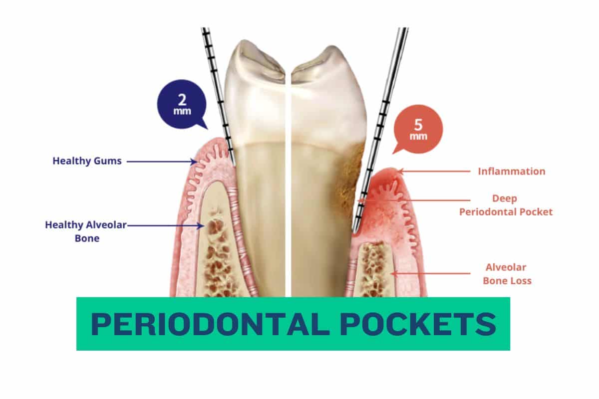 Things to Know About Periodontal Pockets