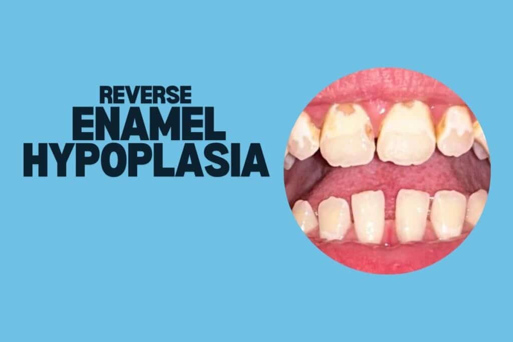 Does teeth whitening help with Enamel Hypoplasia?