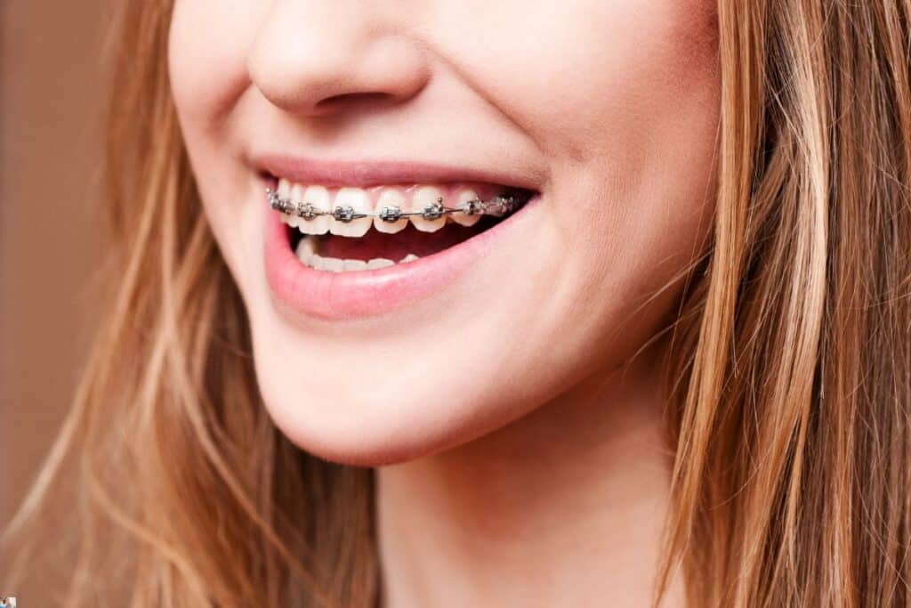 Is Discoloration Normal After Braces?