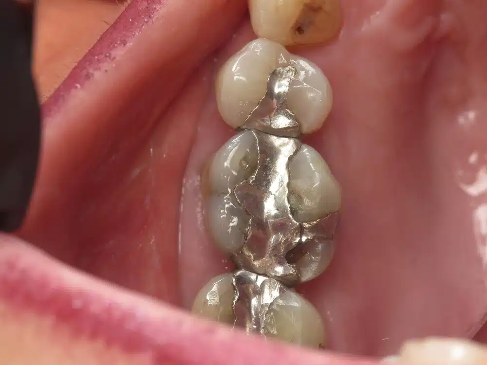 Close-up of dental implant abutment and crown components positioned in oral cavity during procedure.