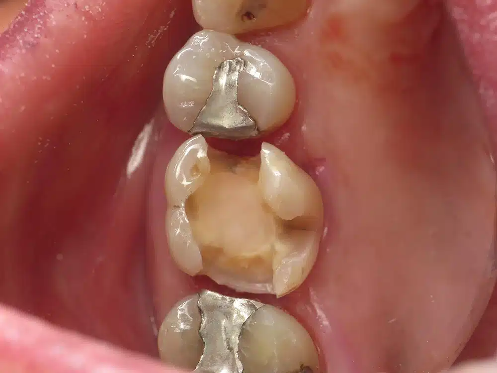 Close-up of dental crowns and restorations on posterior teeth in oral cavity.