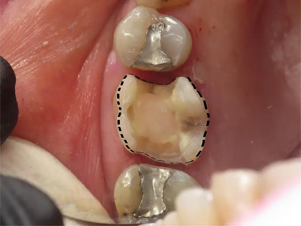 Close-up of three dental crowns or caps displayed against pink gum tissue in dental setting.
