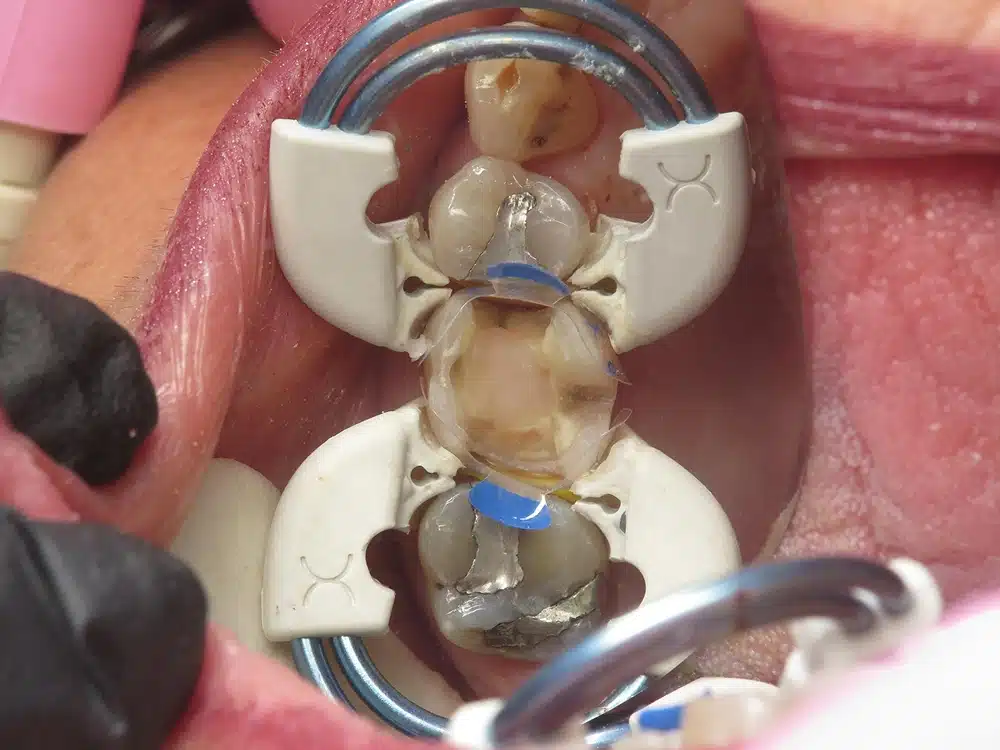 Dental model showing teeth anatomy and positioning on pink dentist's chair with tools