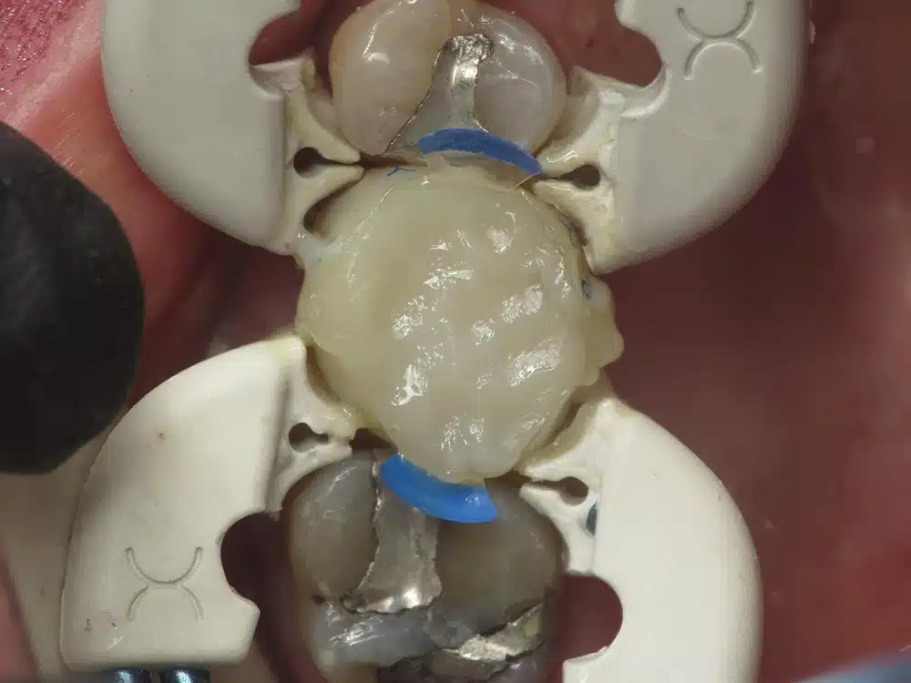 Dental model showing three tooth sections stacked vertically with blue connectors on pink base.
