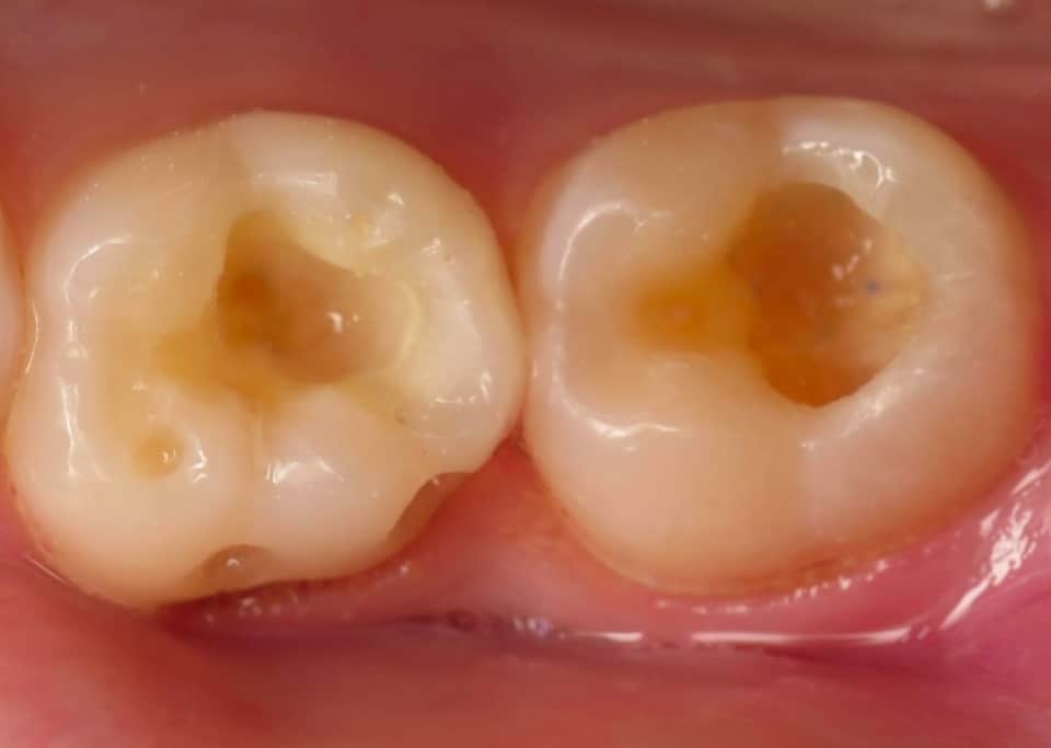Two teeth with severe dental decay and cavities, showing brown discoloration and structural damage.
