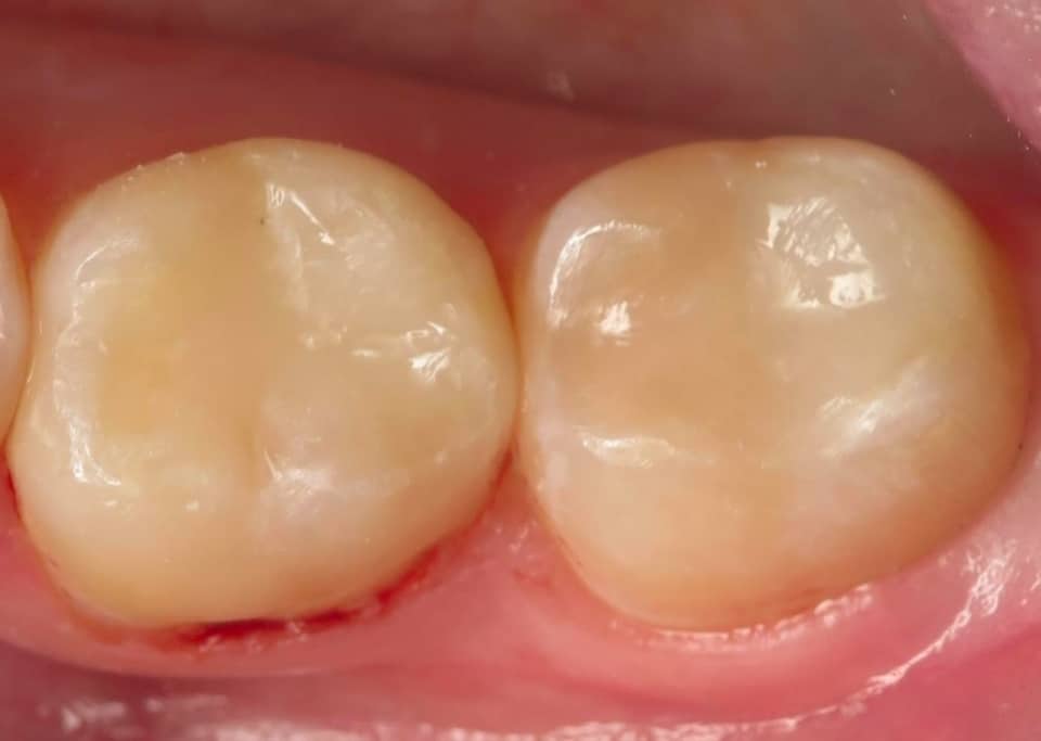 Close-up of two dental crowns on adjacent teeth showing natural appearance and smooth surface integration with gum tissue.