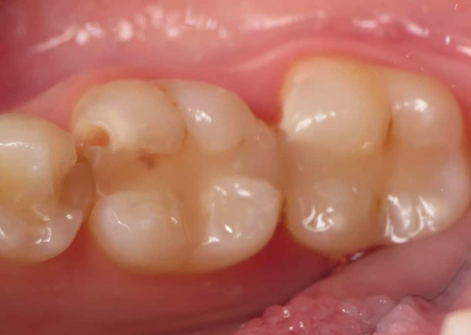 Close-up view of dental crowns and restorations on upper back teeth showing ceramic dental work.