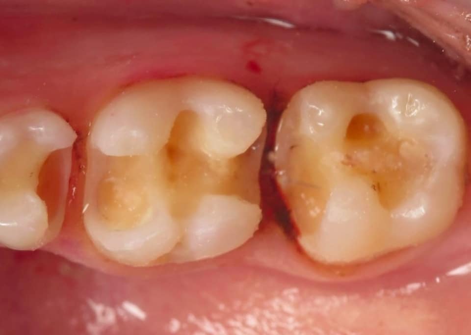Dental cavities on upper molars showing decay and discoloration in patient's mouth.