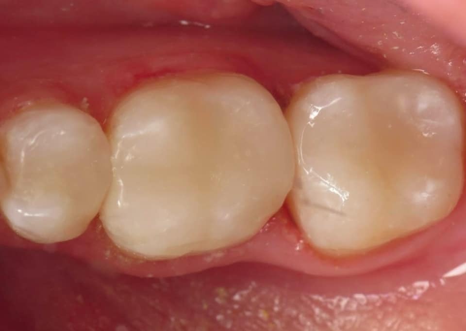 Three natural teeth displayed in oral cavity showing dental health and alignment.